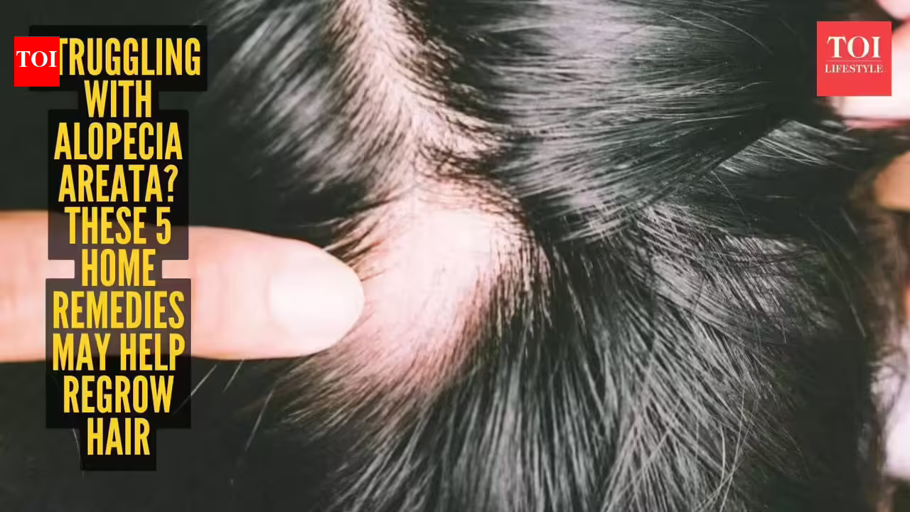 5 sure-shot home remedies that help in hair regrowth in people suffering from Alopecia Areata