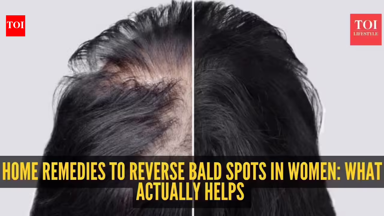 Alopecia Areata remedies: Home remedies to reverse bald spot in women