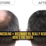 How To Stop Hair Fall: How to reverse hair loss with microneedling and rosemary oil